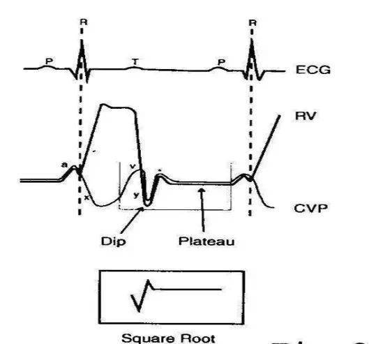 形成舒张中晚期平台,表明心脏舒张受到限制;心室压力曲线形成平方根样