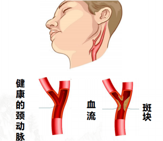 "不忘初心 共筑健康中国梦" ——血管健康中国行活动启动啦_颈动脉