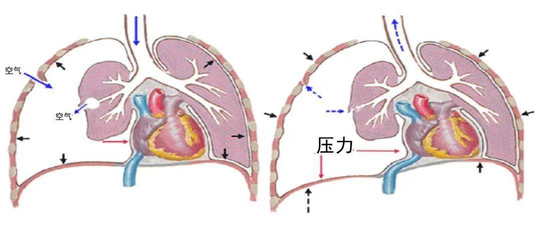 單側胸痛見於胸膜炎,肺炎,氣胸,肋骨骨折,帶狀皰疹,肋間神經炎等.