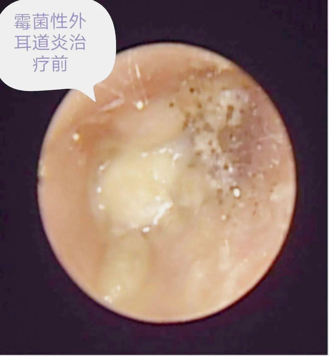 在内镜室,刁护士用耳内镜检查,发现贴近鼓膜处有一白色异物,用专用