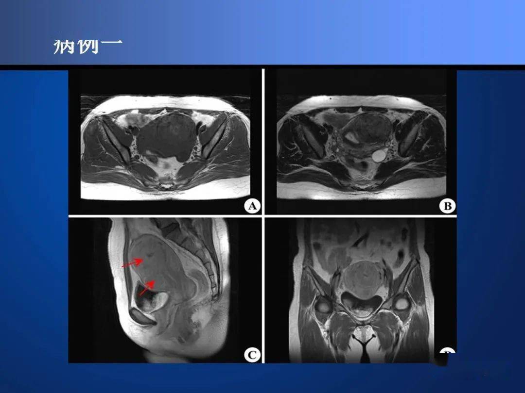 子宫肌瘤的影像学及病理学诊断
