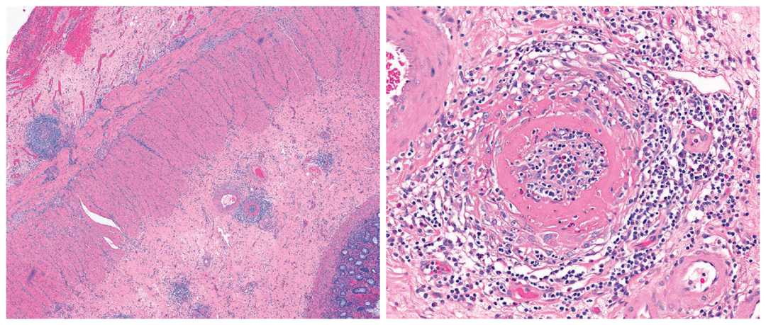 右半结肠切除标本,肠壁全层切片,可见累及小至中等动脉的血管炎