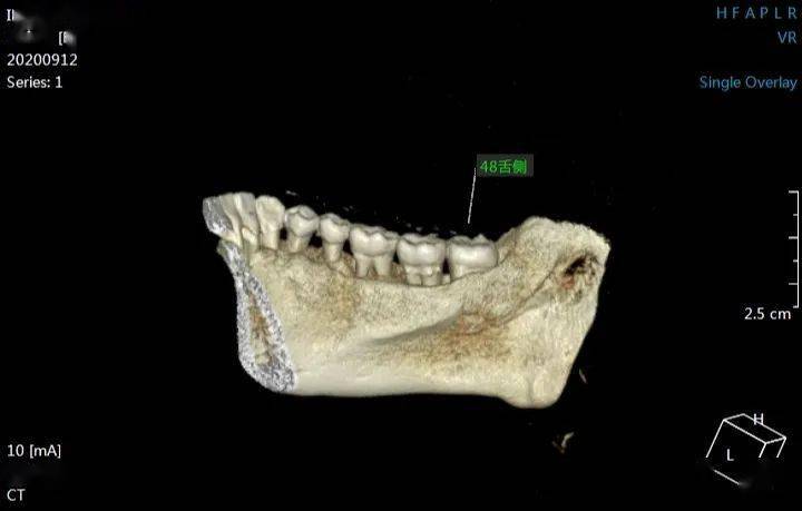 47远中牙槽骨吸收至根尖三分之一区48根周可见低密度阴影,阴影和根尖