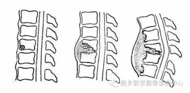 脊柱结核分型图片详解