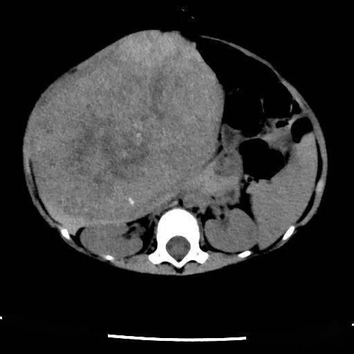 肝母细胞瘤肚子图片