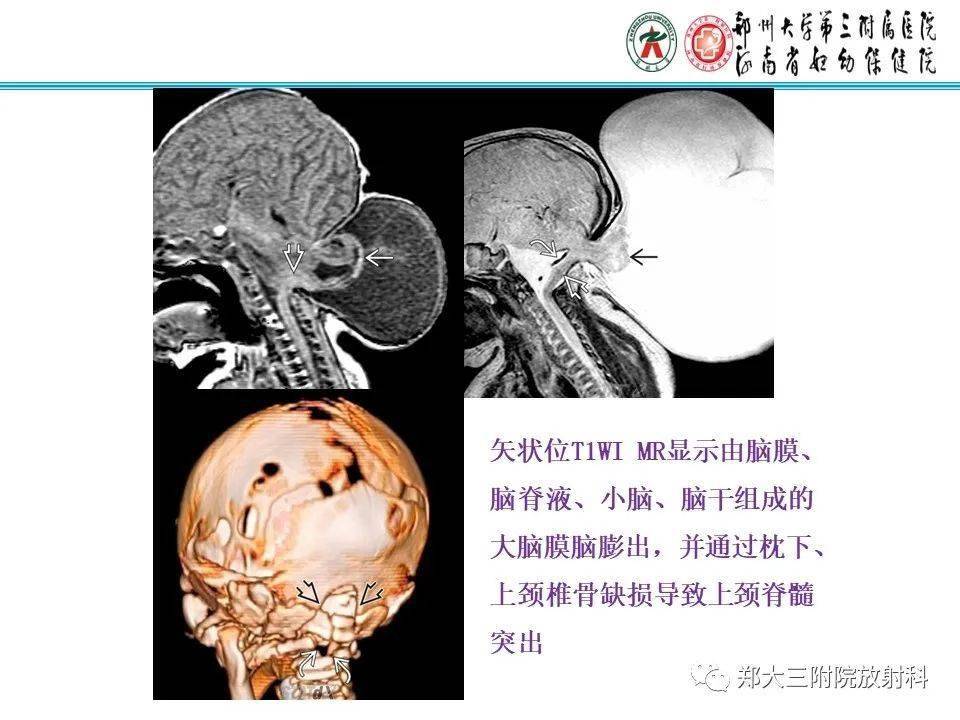 小脑扁桃体ct解剖图片