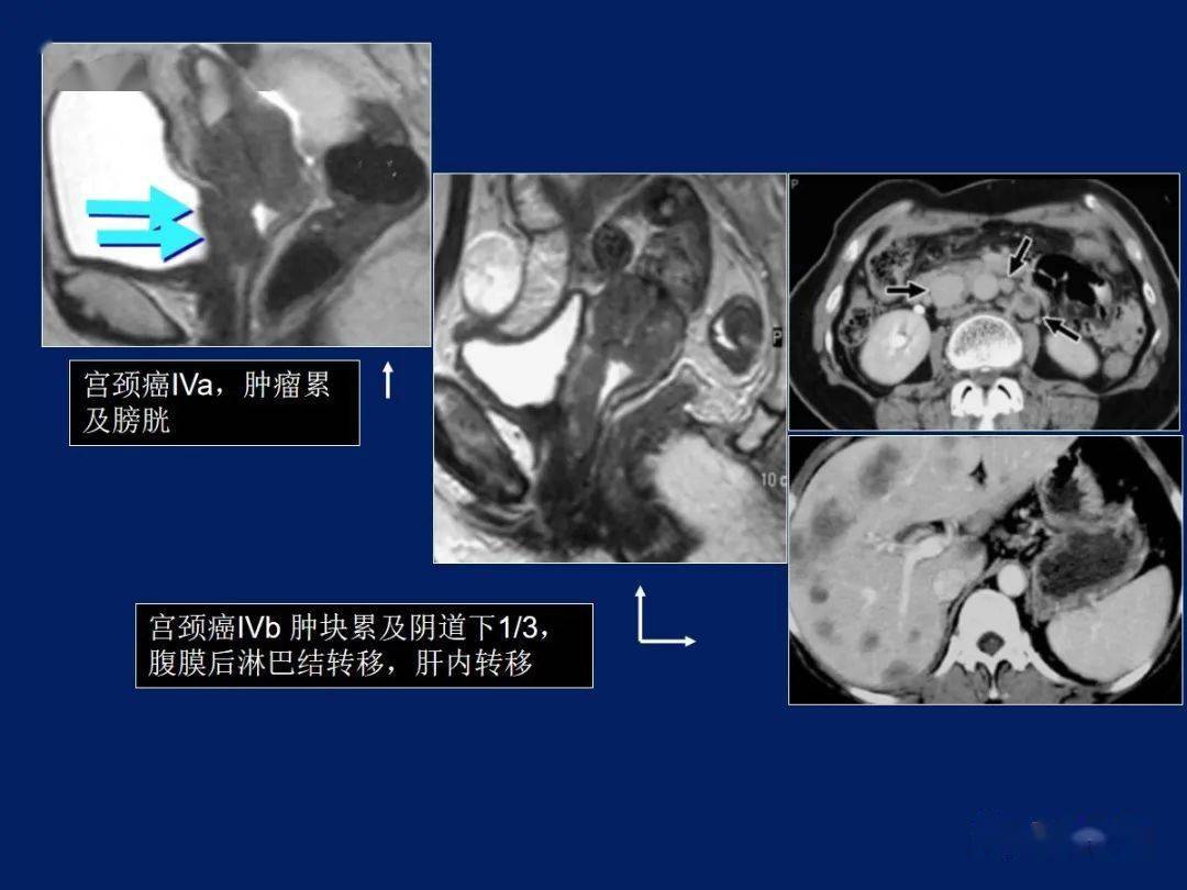 妇产科常见疾病MRI表现_子宫