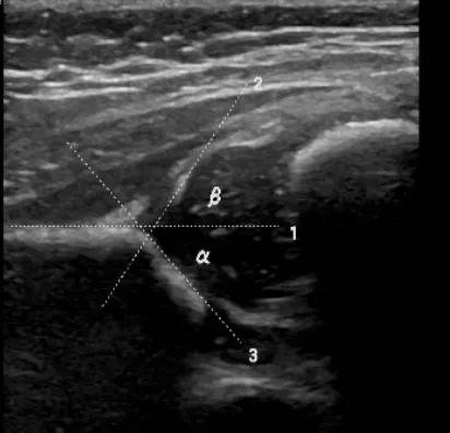 你家宝宝做了婴幼儿髋关节超声检查吗