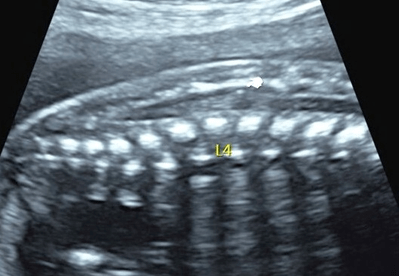 胎儿脊髓栓系图片
