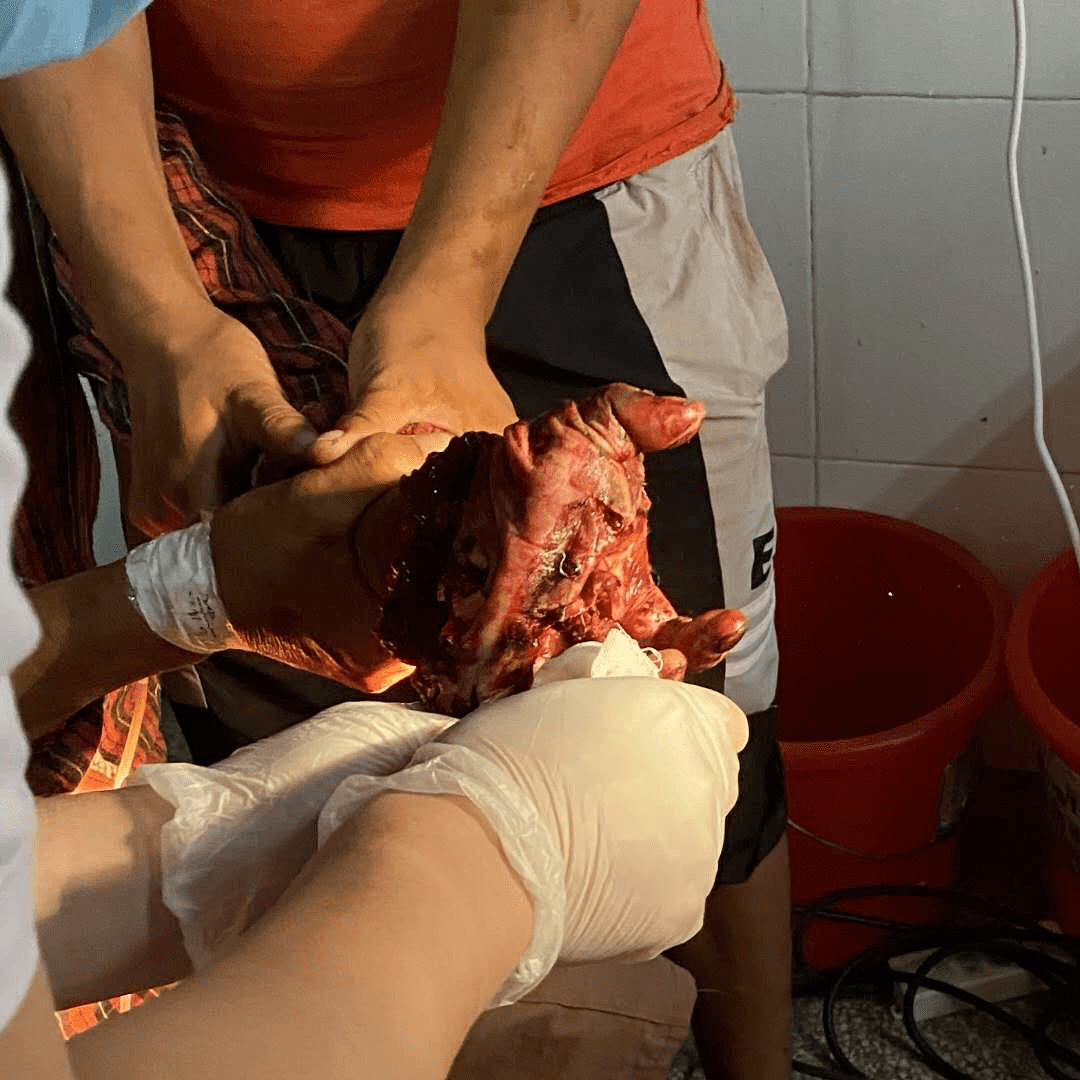 收割机"咬人",协和医院紧急"救人"