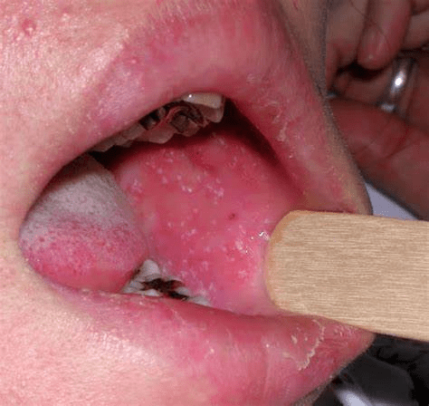 麻疹是由麻疹病毒引起的急性呼吸道传染病.