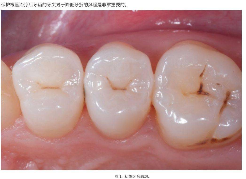 【病例分享】前磨牙根管治疗后的高嵌体修复