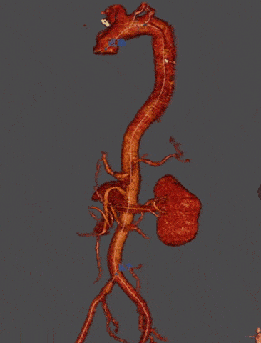 医院血管介入外科应用castor03分支型覆膜支架治疗主动脉夹层1例