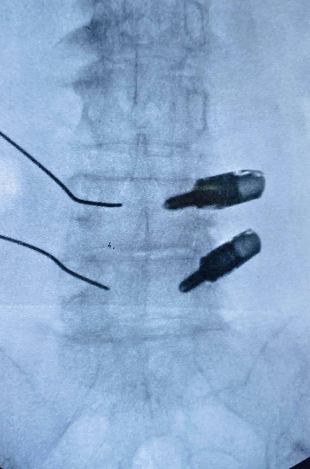 腰椎间盘手术钢钉图片图片