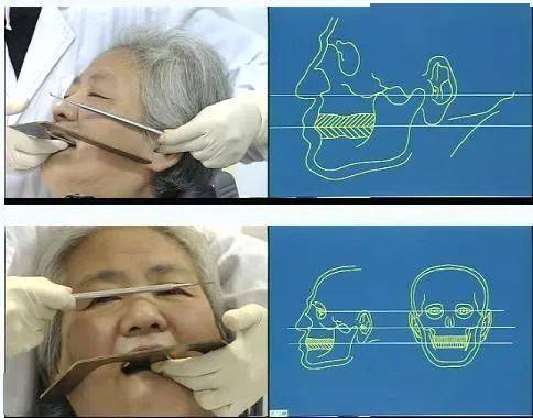 【牙医必备】全口义齿垂直距离确定图解!