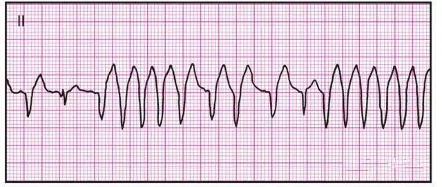 干货14种异常心电图的波形特点