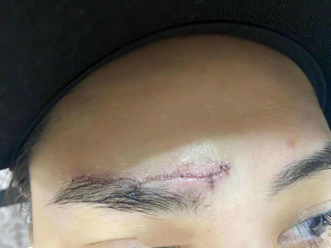 首晒伤口照香港著名靓女艺人眉骨留下近5厘米蜈蚣疤伤痕清晰可见