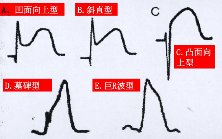 st段弓背向上抬高图片图片