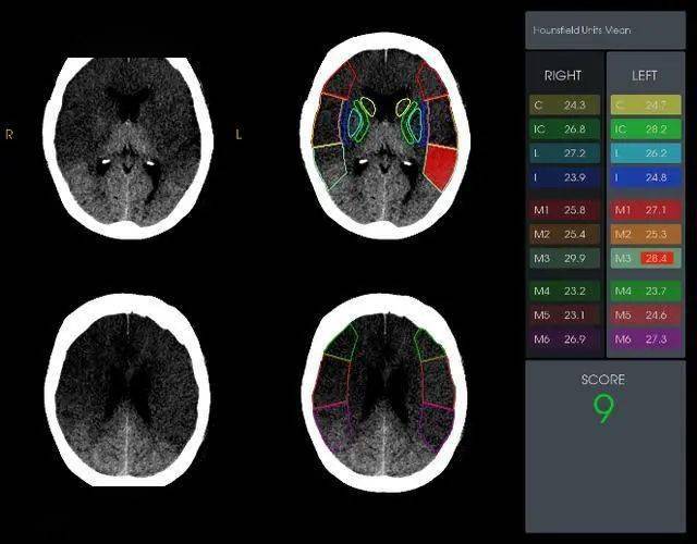rapidai缺血aspects评分rapidai脑血管cta分析出大血管闭塞rapidai ct