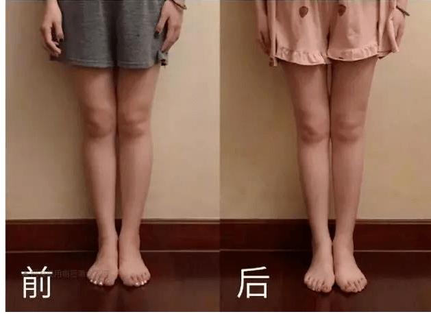胖腿和瘦腿对比照片图片