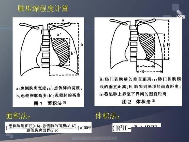 气胸肺压缩程度的估算（图文详解）_方法