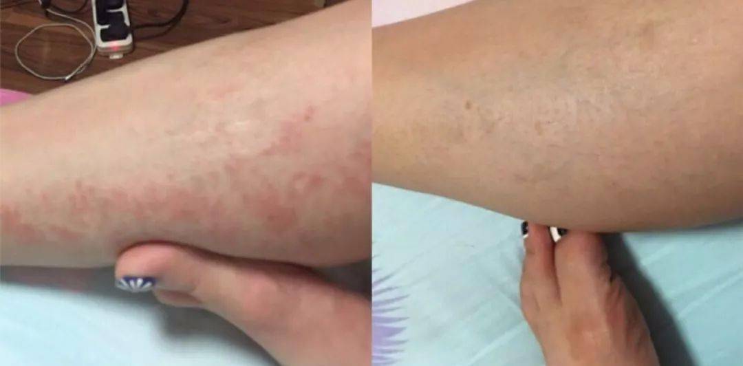 湿疹皮炎有救了传承千年的西域神药抹一抹10秒止痒3天去湿疹永不复发