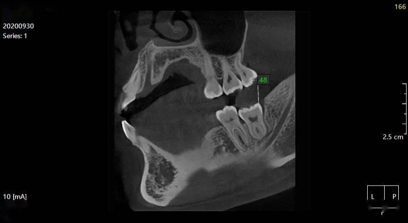 张xx 20201001 智齿cbct 136xxxx7233_下颌