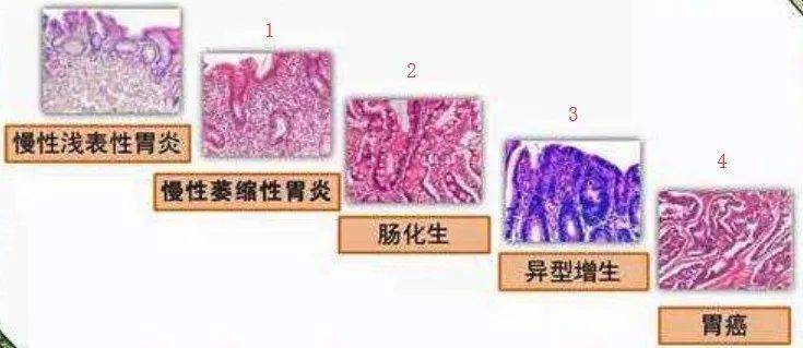 慢性萎縮性胃炎是不是很容易變癌離胃癌還有多遠