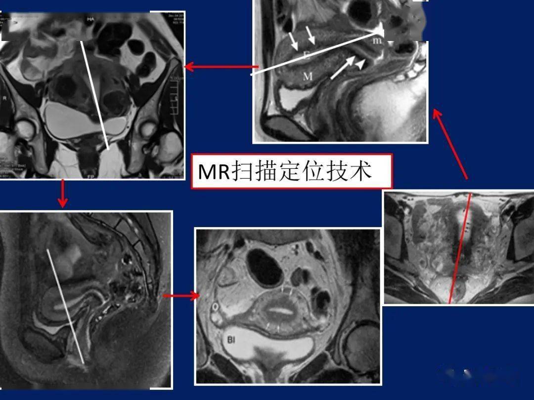 子宫MR解剖图片