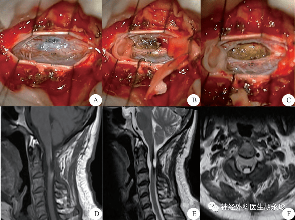 脊髓血管畸形复合手术图片