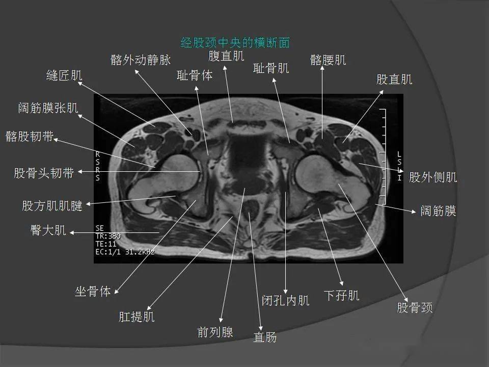 盆腔ct解剖图详细图图片