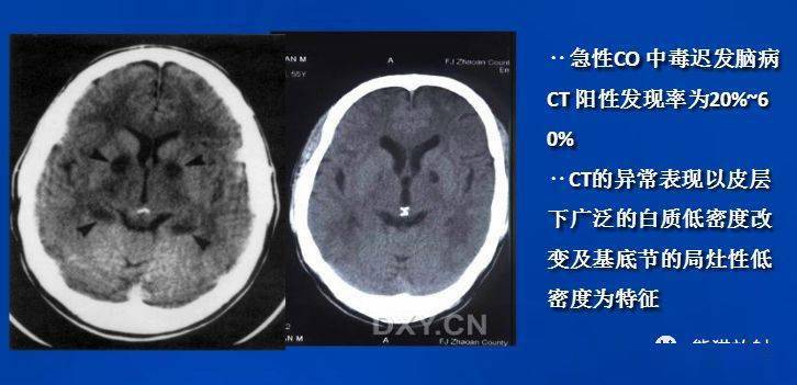 一氧化碳中毒性脑病