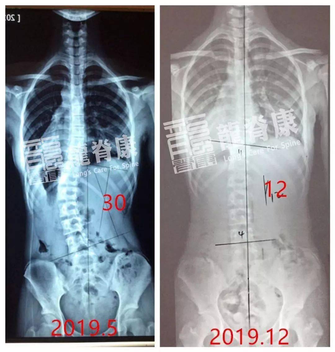 2006年出生的廣西小朋友,2019年5月發現脊柱側彎,cobb角30°,體態很不