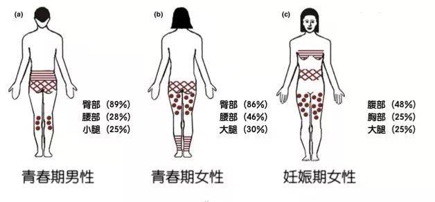 身體上的膨脹紋和萎縮紋你聽說過嗎