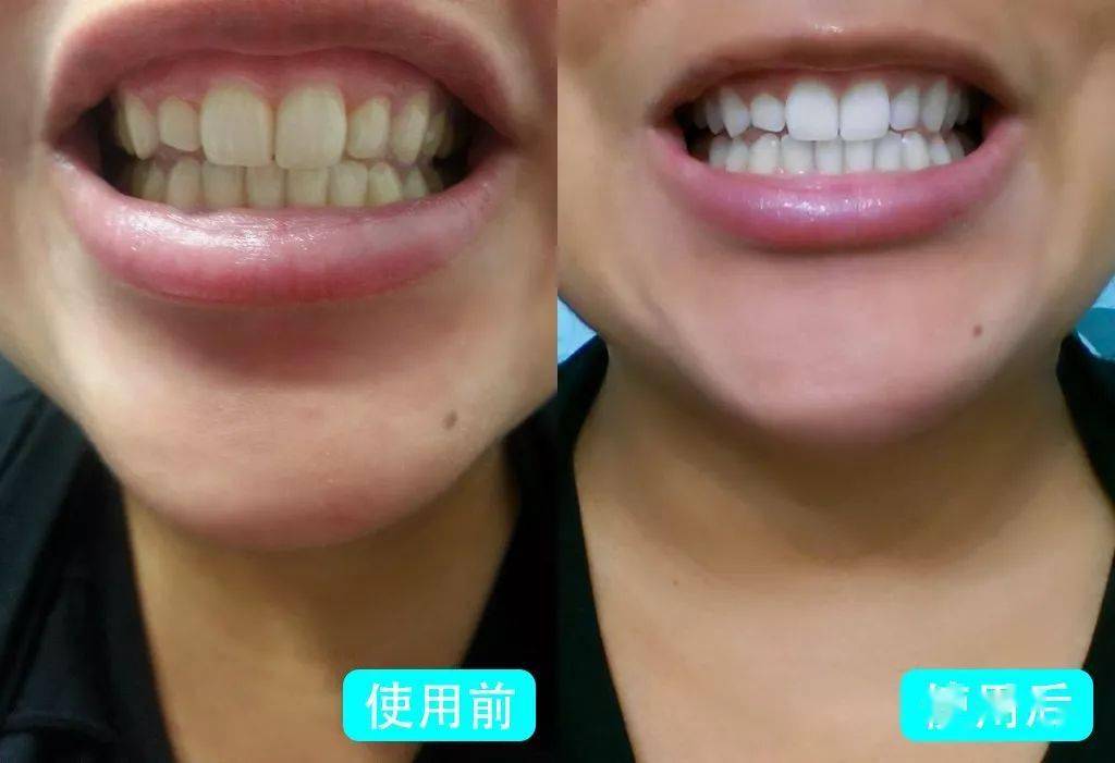 用这款牙膏刷一刷,3秒除口臭,10秒去除大黄牙.