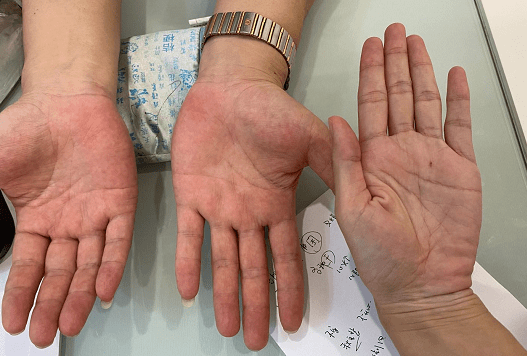 小心赶紧转发给身边的人如果手指出现这种改变可能是早期肺癌