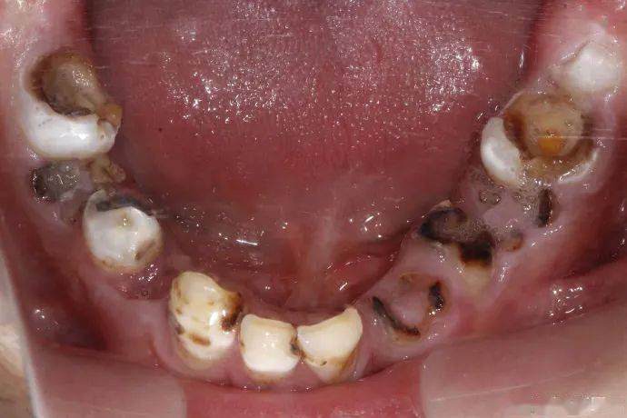 (@西安牙医亓)在微博分享了一个病例,并发微博称: "碳酸饮料害死牙啊!