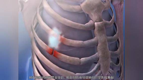 动画演示气胸原来是这么回事