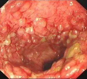 肛周脓肿指肛门直肠周围软组织感染所形成的化脓性疾病