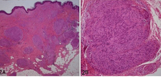 今日病例丛状神经鞘瘤伴局限性多毛症