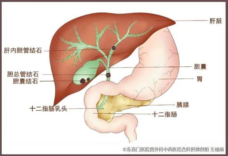 中西医并重显神通东直门医院普外科为胆石症患者保驾护航