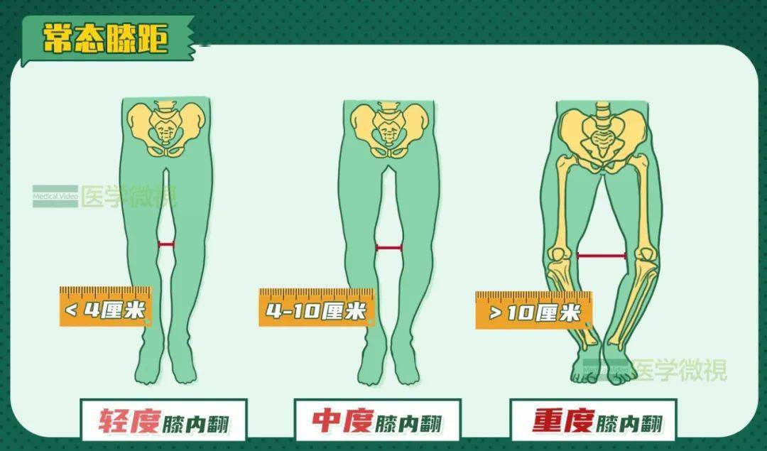 这些人,如果脚尖朝前来测量,两个膝关节之间的距离可能会很大,并非