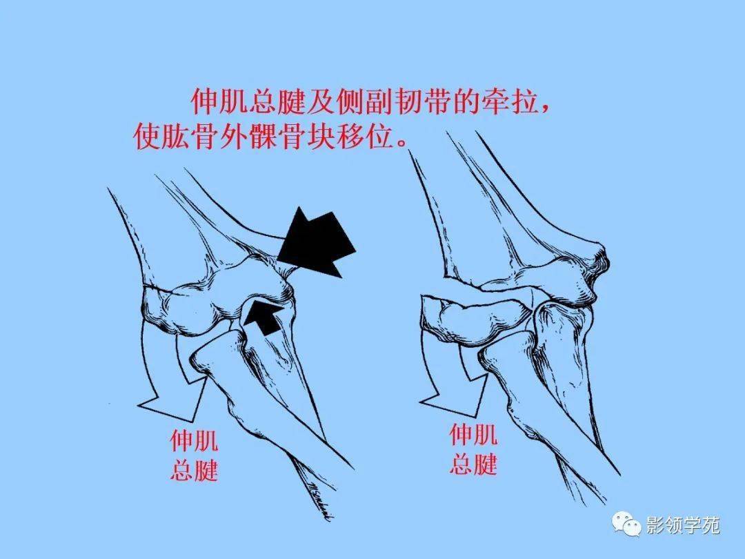 儿童骨折的类型及影像特点