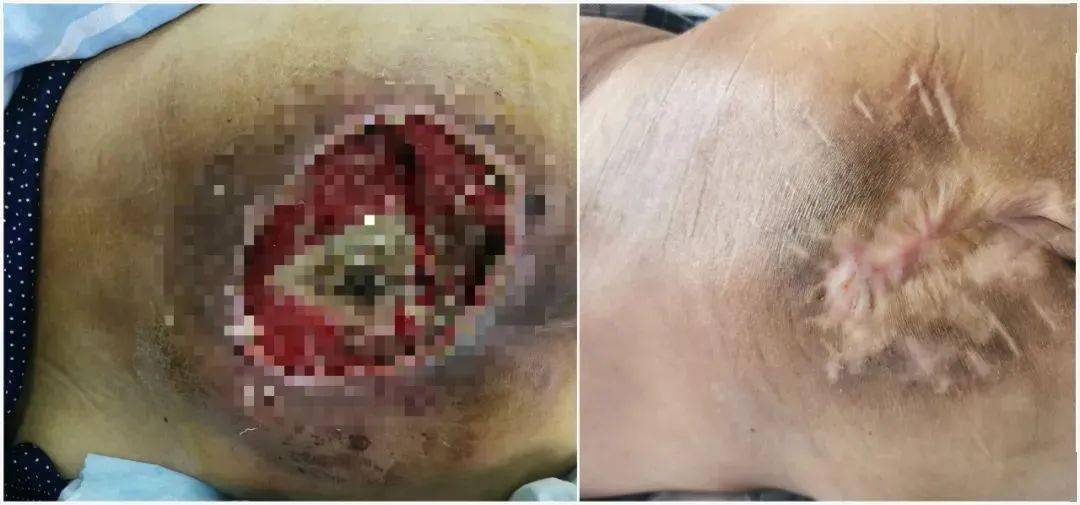 小小的皮肤破溃迅速恶化她被下了病危通知书如何起死回生