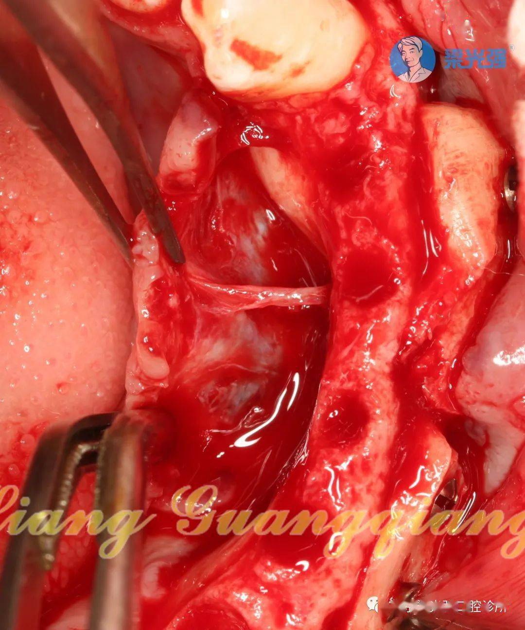 牙医学堂难度高度升级自体骨块移植