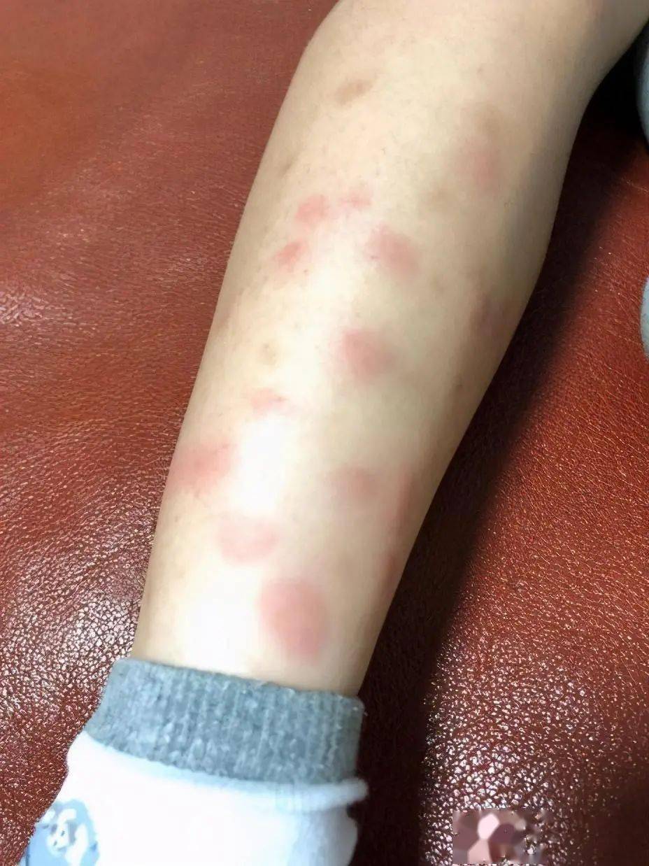 西湖边玩了会5岁宝宝腿上全是疹子杭州一堆孩子中招这玩意太毒了
