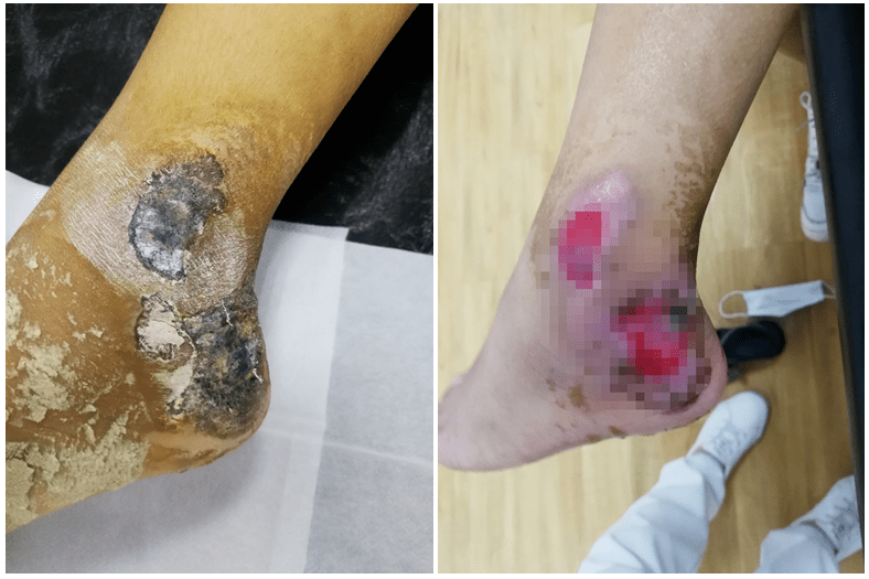 伤口看似结痂了,但足跟位置特殊,血液循环不好,结痂下的皮肤根本就不