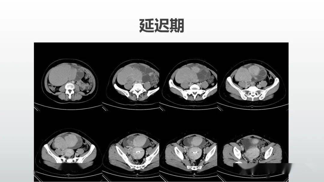 卵巢粘液性囊腺癌图片