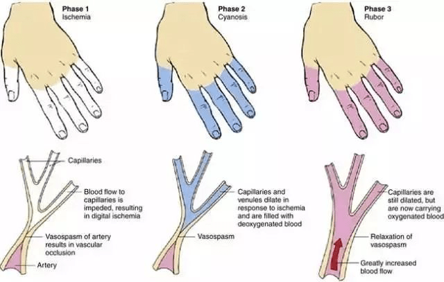 生理性雷诺现象图片
