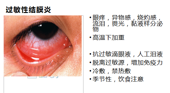 【小学生眼健康家校课堂】过敏性结膜炎患者逐年增加——保定责任